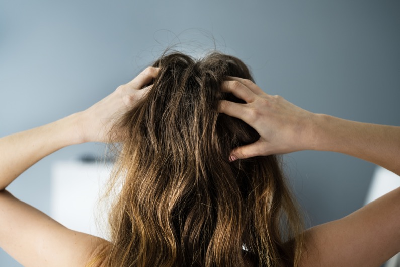 Itching Dry Head Scalp And Long Hair With Dandruff